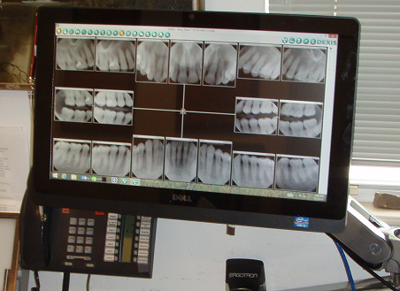 Dental x-ray on office computer screen